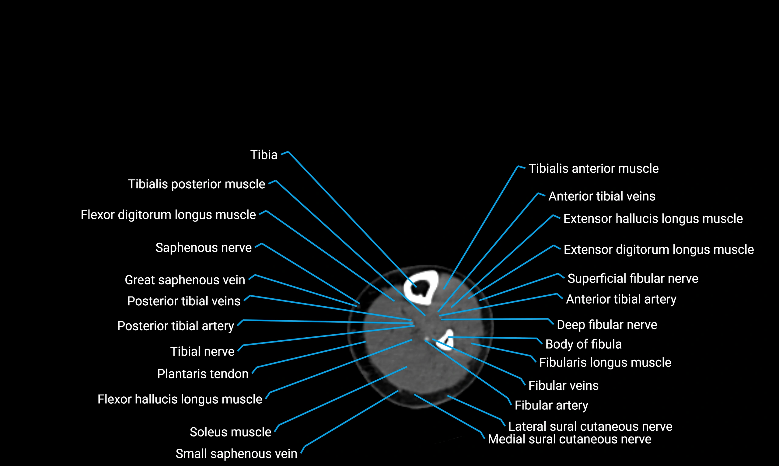 CT lower limb axial cross sectional anatomy labelled image 124 (2).webp